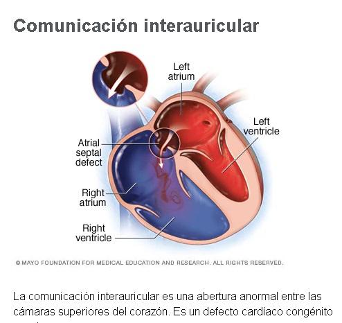 comunicación interauricular