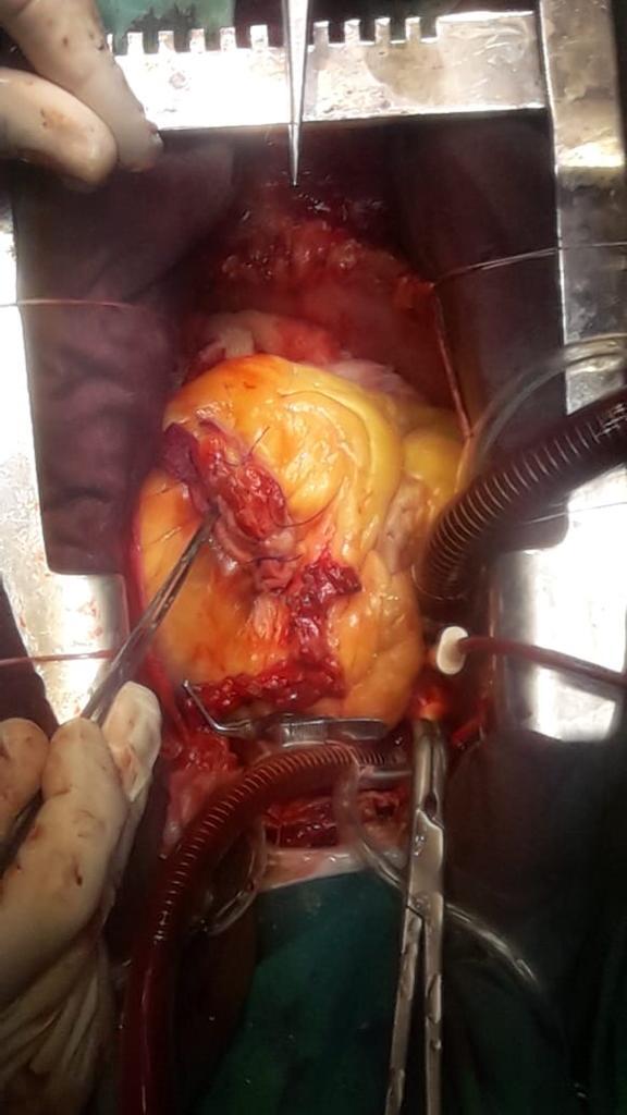 ANEURISMA DE VENTRÍCULO IZQUIERDO