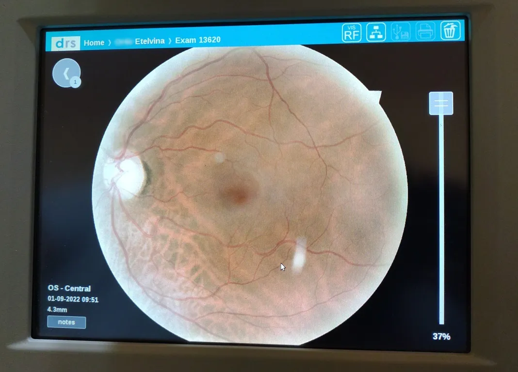 retinografo 5 (FILEminimizer)