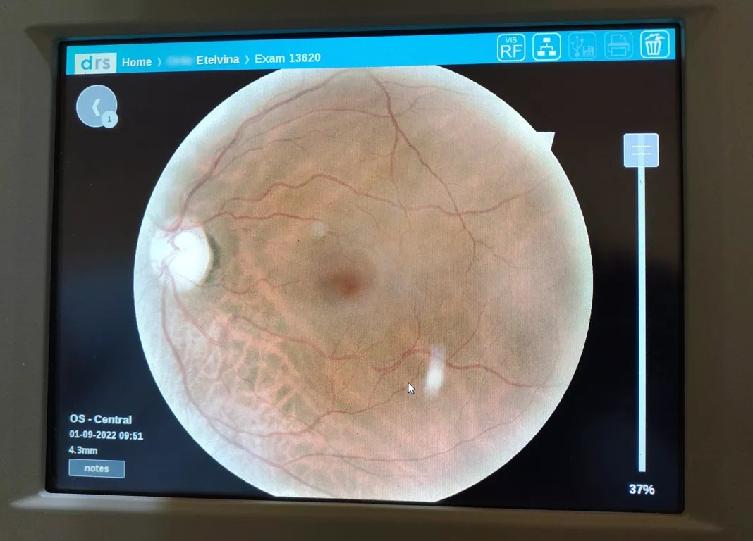 retinografo 5 (FILEminimizer)