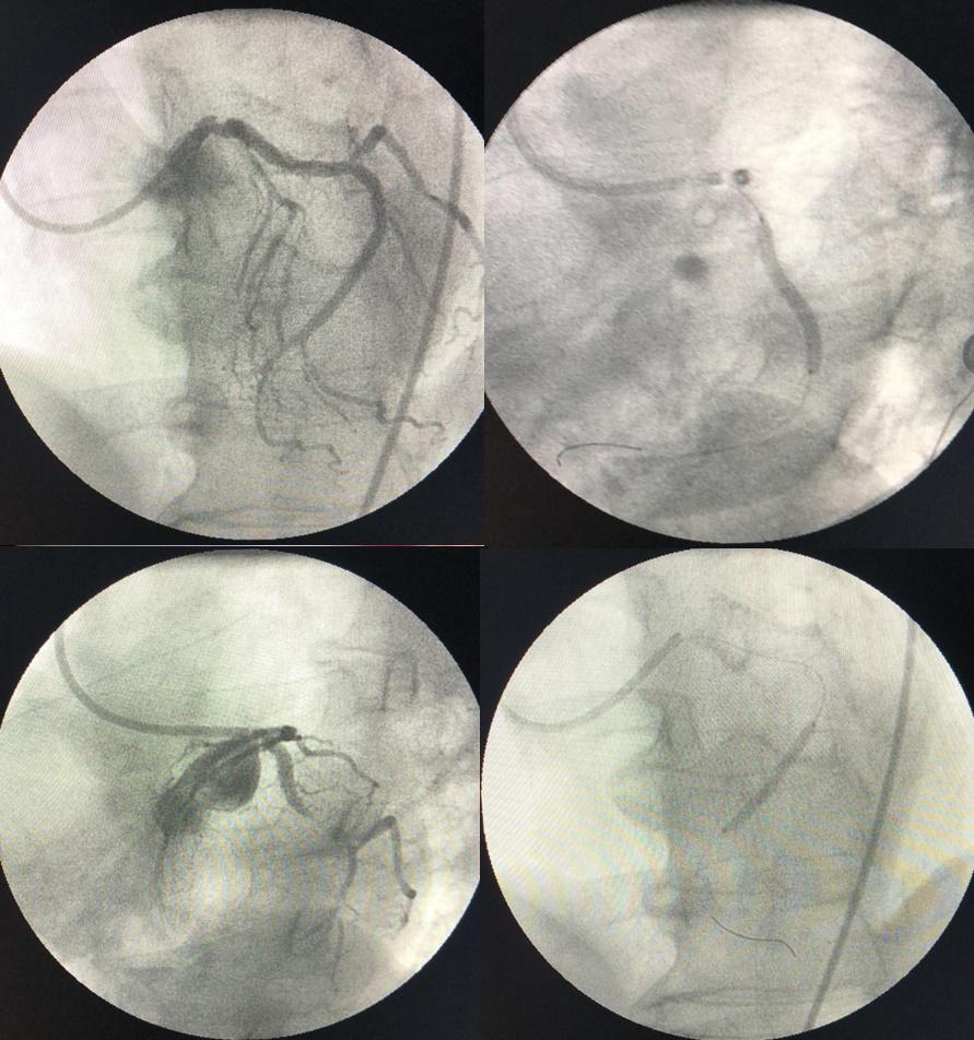 Angioplastia
