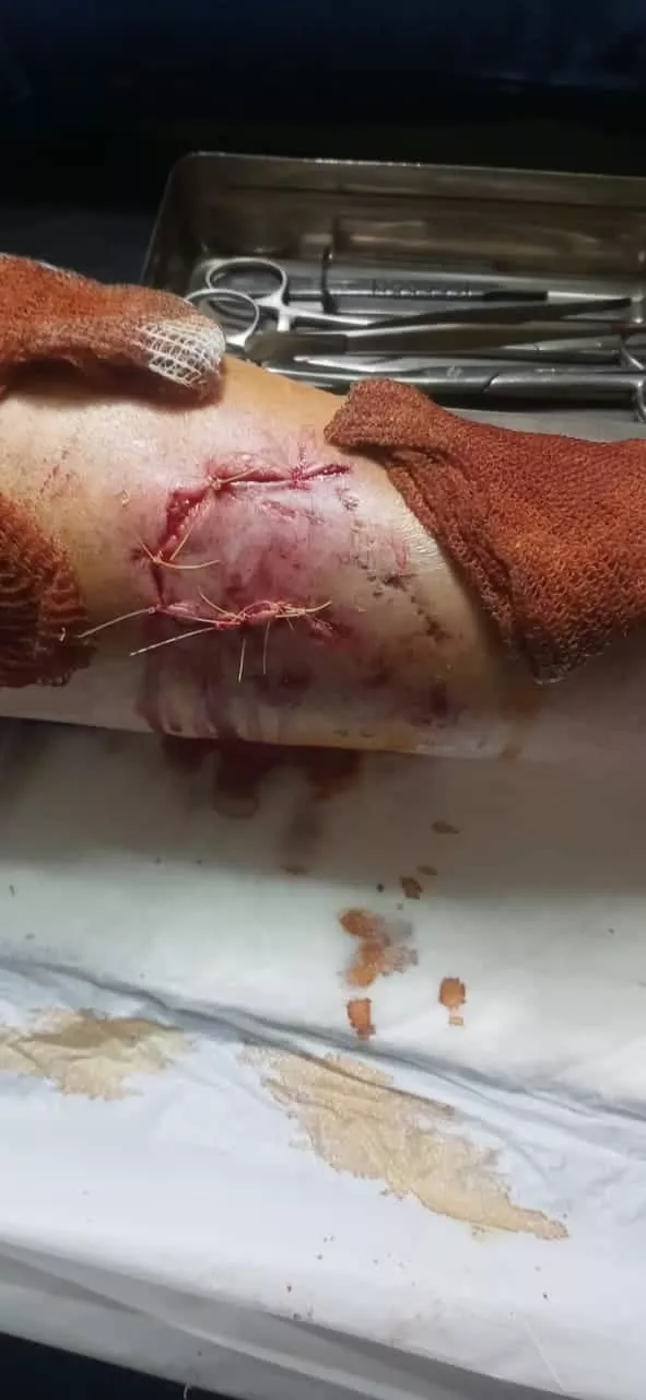 mordedura perro huinca