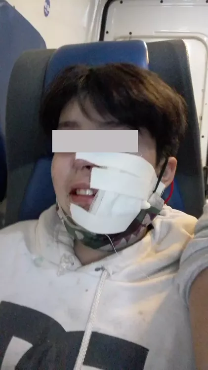 niño mordido perro 2 edit