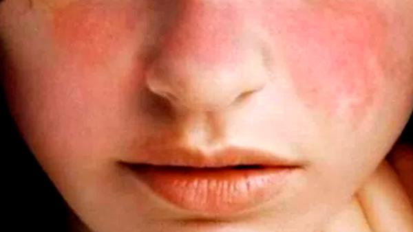 LUPUS
