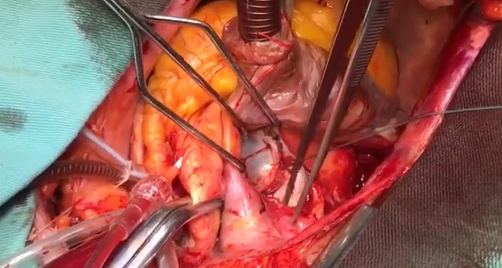 Reemplazo de válvula mitral biológica