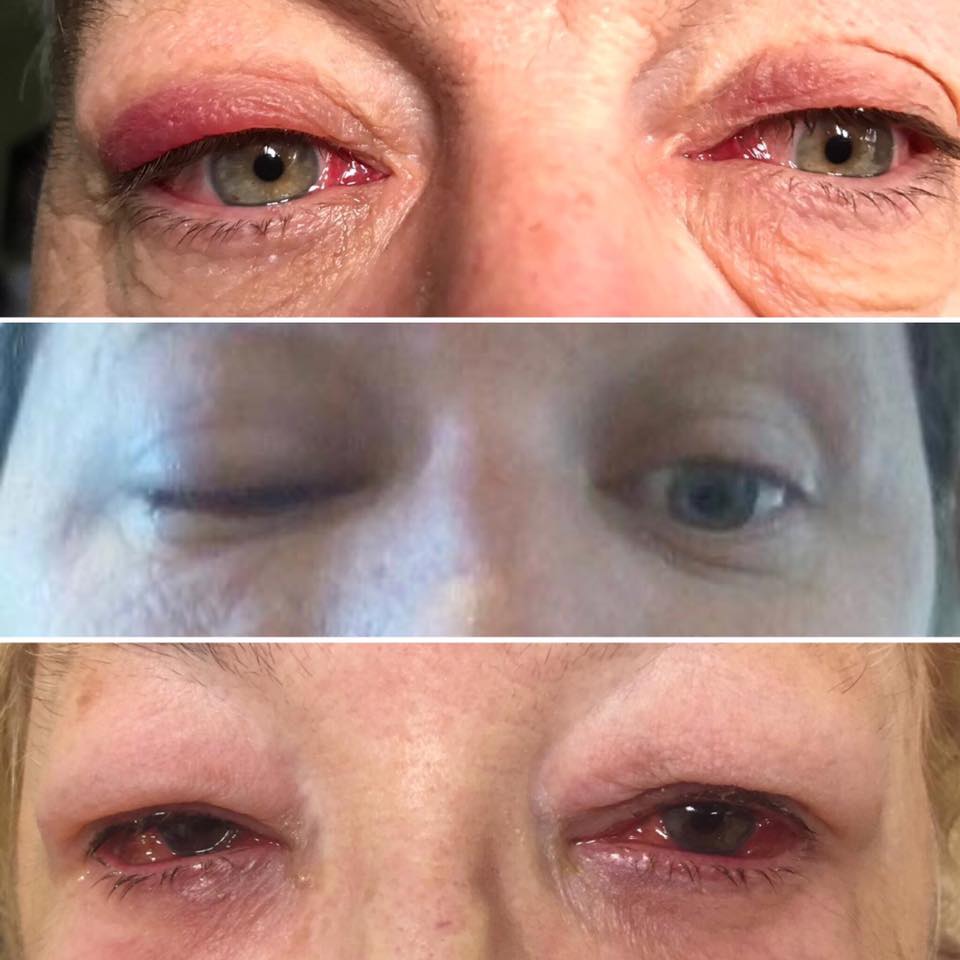 CONJUNTIVITIS VIRAL