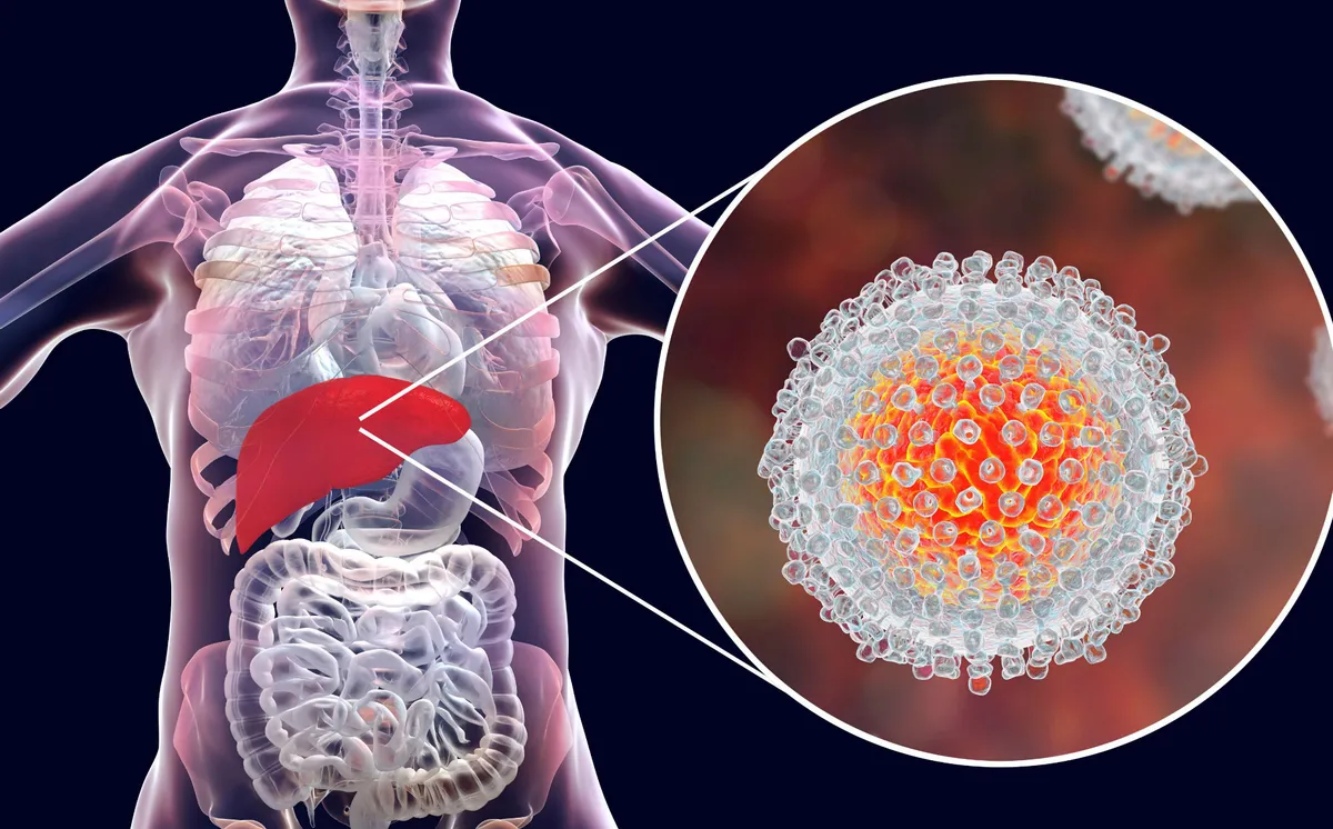 hepatitis aguda