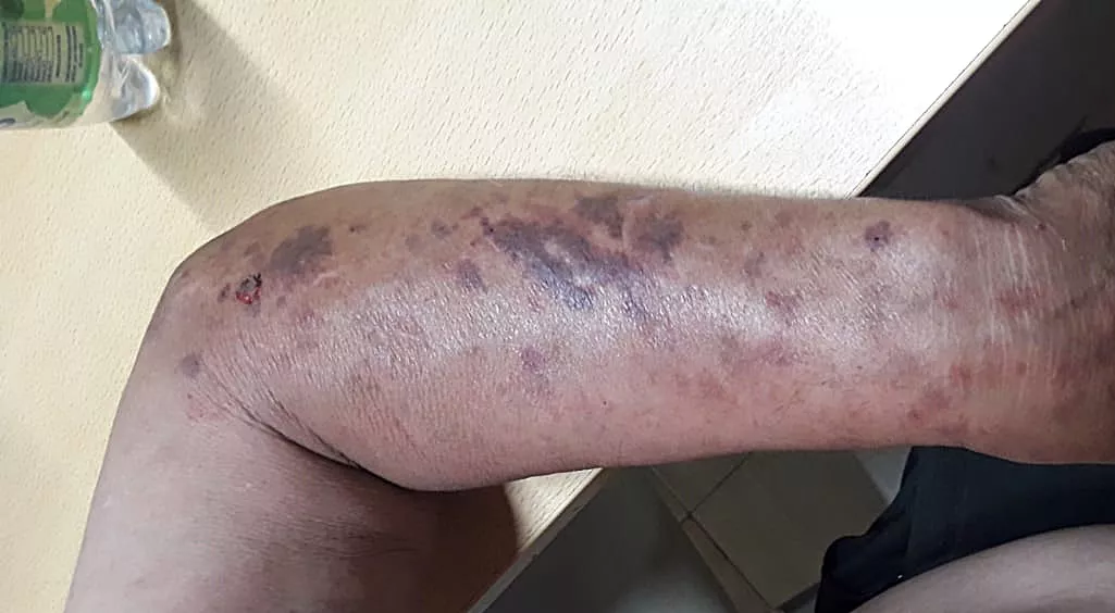 golpeado 2