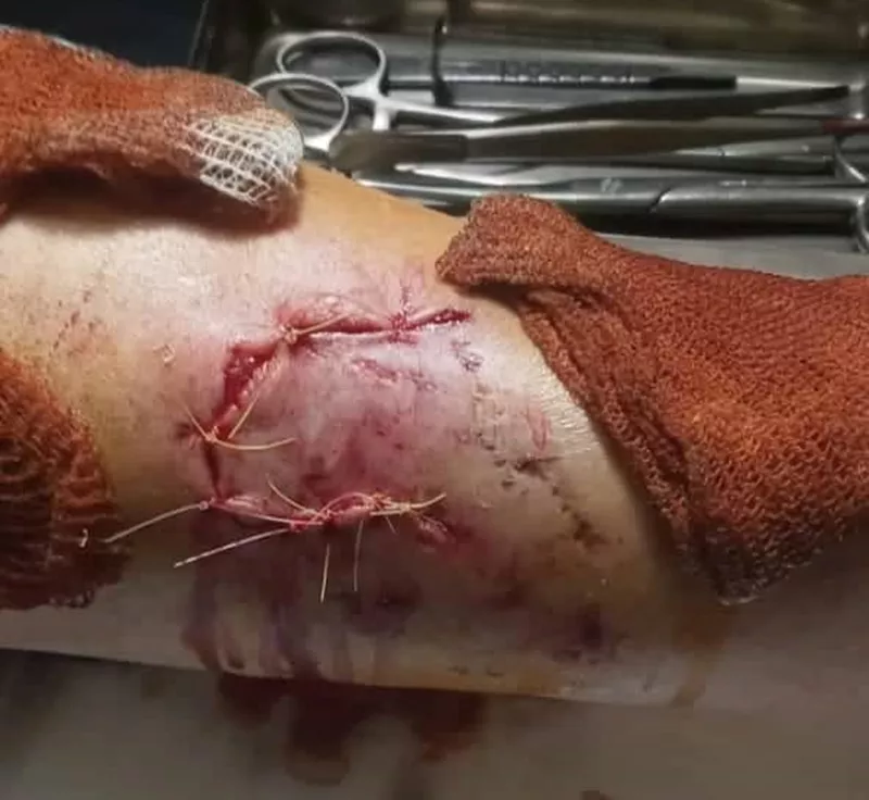 mordedura perro huinca 2